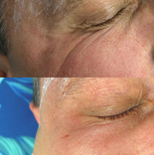 Kwas Polimlekowy PLLA - Innowacyjny Biostymulator Kolagenu Wrocław