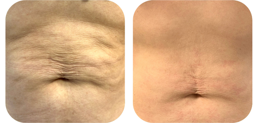 Zabieg HiFu - Redukcja Zmarszczek i Ujędrnienie Skóry | Yasumi Legnicka