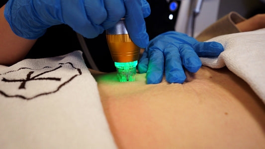 Frax RF – mikronakłucia z falą radiową dla spektakularnego odmłodzenia skóry