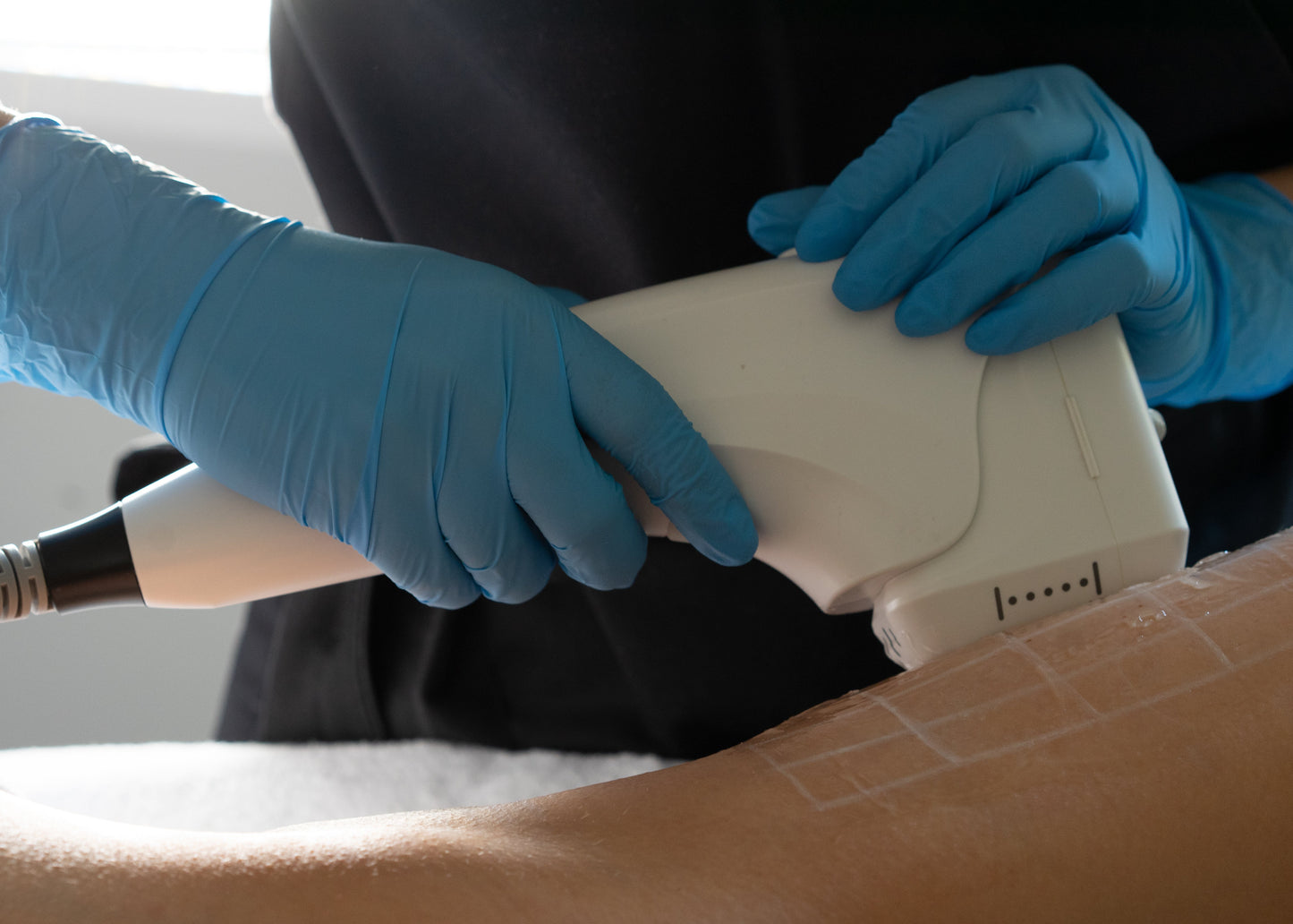 Zabieg HiFu - Redukcja Zmarszczek i Ujędrnienie Skóry | Yasumi Legnicka