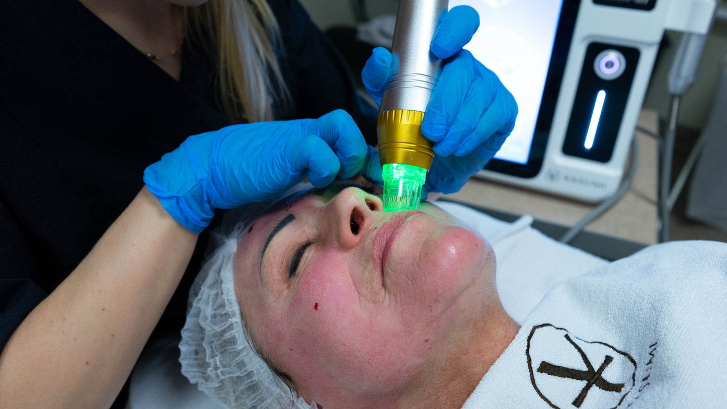 Frax RF – mikronakłucia z falą radiową dla spektakularnego odmłodzenia skóry