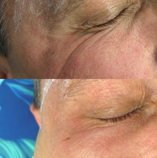 Kwas Polimlekowy PLLA - Innowacyjny Biostymulator Kolagenu Wrocław