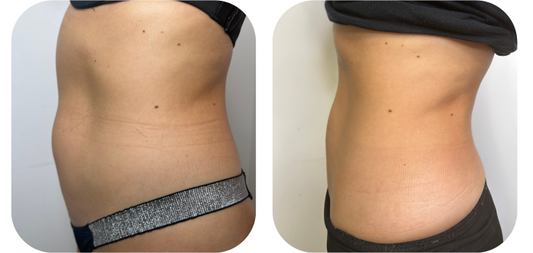 Kriolipoliza - Zabieg Zamrażania Tkanki Tłuszczowej