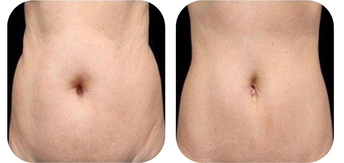 Pakiety Modelujące Sylwetkę - Kompleksowe Zabiegi