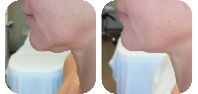 Zabieg HiFu - Redukcja Zmarszczek i Ujędrnienie Skóry | Yasumi Legnicka