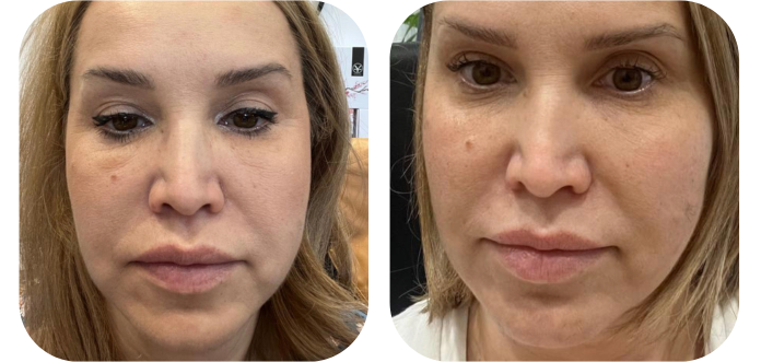 Zabieg HiFu - Redukcja Zmarszczek i Ujędrnienie Skóry | Yasumi Legnicka